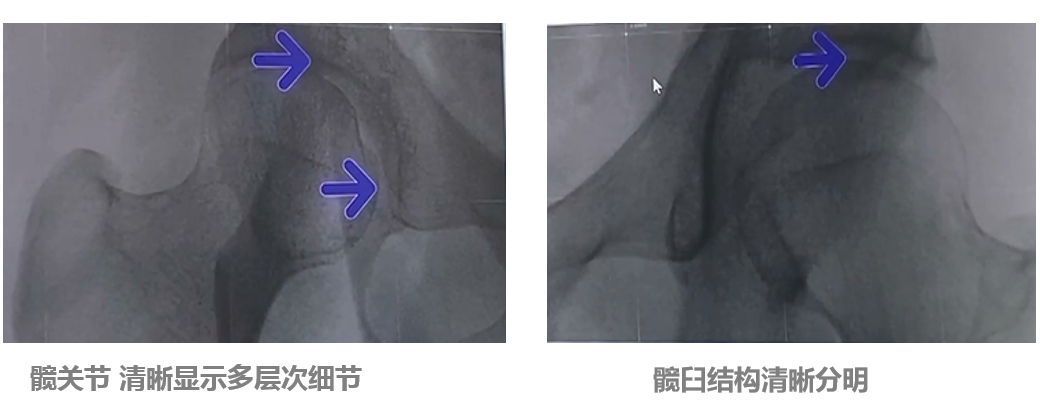 平板小C髖關(guān)節(jié)成像效果