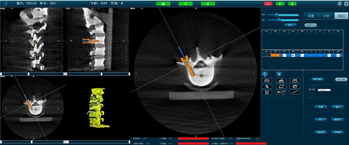 脊柱微創(chuàng)手術(shù)機(jī)器人-定位準(zhǔn)確