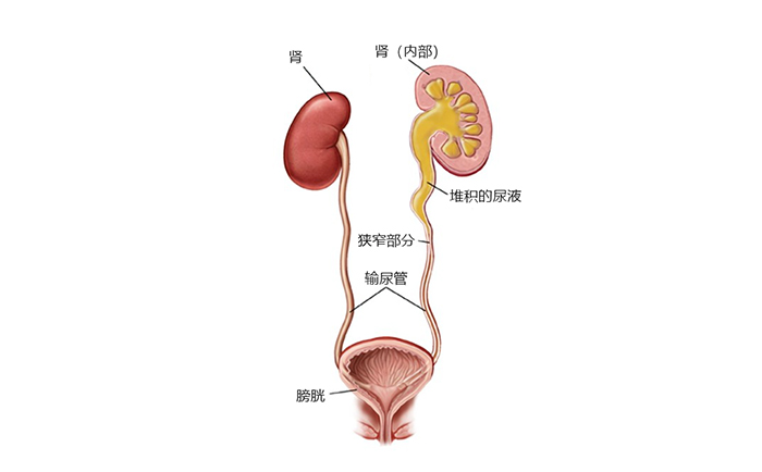 輸尿管狹窄導(dǎo)致尿液堆積