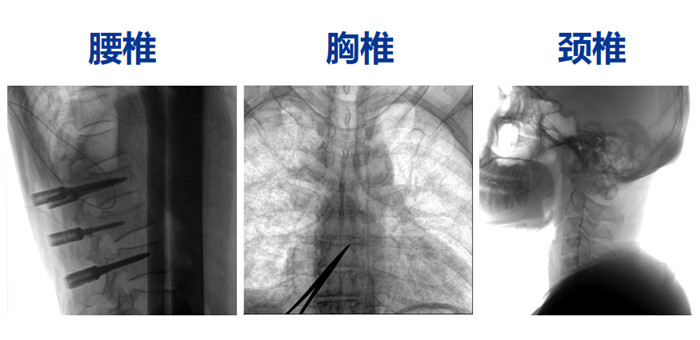 骨科手術(shù)機器人能做什么手術(shù)