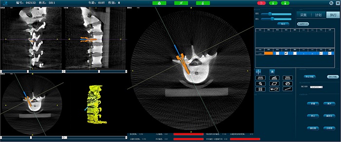 PL300B脊柱外科手術(shù)導(dǎo)航定位系統(tǒng)-操作界面
